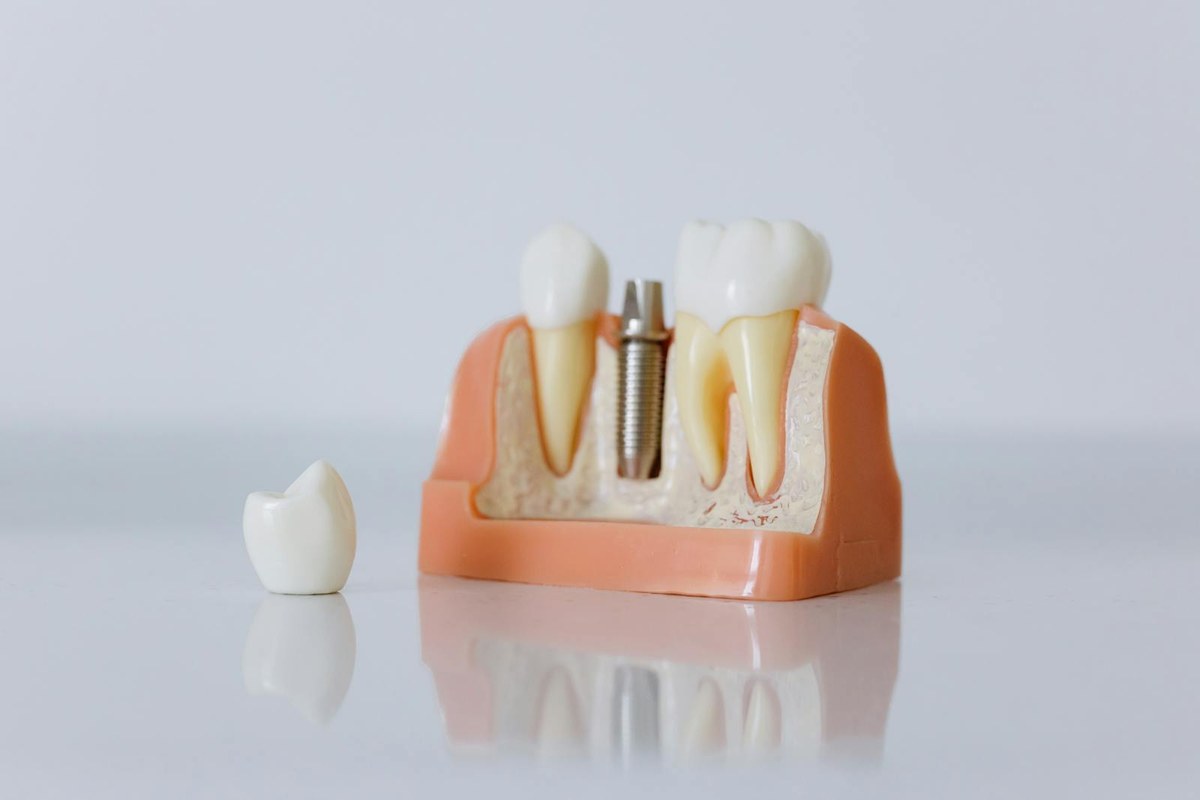 Implante dentário — modelo com coroa sobre raiz em titânio
